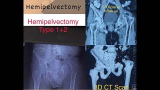 Hemipelvectomy  Life with or without Hip Joint [upl. by Enitsirk]