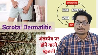 अंडकोष पर होने वाली खुजली का कारण  Part 1 Scrotal Dermatitis  Scrotal Eczema scrotaldermatitis [upl. by Rehm457]