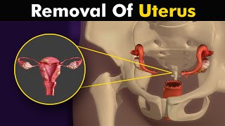 What happens in hysterectomy Uterus Removal surgery animation [upl. by Herv148]