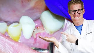 Dentist Explains TOOTH PAIN AFTER EXTRACTIONS Throbbing Dry Socket amp Aching For Days After [upl. by Alverta]