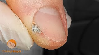 I trim the nails remove the calluses and clean the grooves to relieve discomfort in the feet [upl. by Adlee]