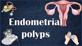 Endometrial Uterine Polyps  Everything You Need To Know [upl. by Tonia]