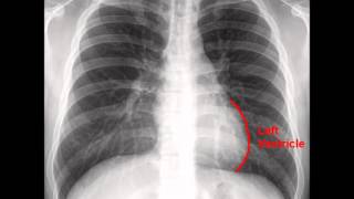 Chest XRay CXR Analysis in a Nutshell [upl. by Jeffrey637]