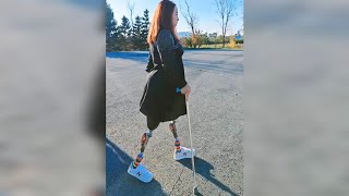 Amputee Girl Walking Smart with a Stick  DAK Amputee  Double Prosthesis [upl. by Nylqcaj]