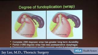 Surgery and the Esophagus  What does minimally invasive mean  Dr Jay Moon Le [upl. by Ikaz]