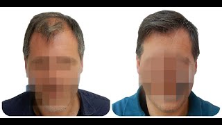 Is Hair loss reallly solved using FUE hair restoration [upl. by Dhiman]