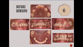 Different Types of Malocclusion  Treatment at BPKIHS Dharan Department of Orthodontics [upl. by Isidore]