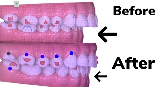 INVISALIGN OVERBITE UPDATE 16 Months [upl. by Delorenzo]