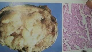 Thyroid Neoplasm medical pathology mbbs [upl. by Gile]