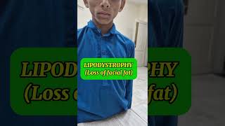 Lipodystrophy  lipoatrophy  signs amp symptoms [upl. by Schwejda996]