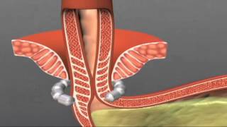 LINX System for reflux disease GERD [upl. by Akem]