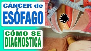 Cáncer de Esófago  Diagnóstico [upl. by Yemac]