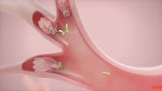 How It Works Zephyr Valve Treatment for COPD amp Emphysema [upl. by Bronder]