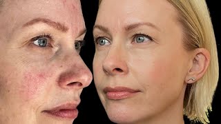 HOW I FIXED my rosacea ‼ [upl. by Aihseyt]