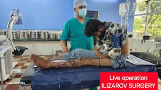 ILIZAROV SURGERY LIVE IN TIBIA FIBULA FRACTURE INFECTION TREATMENT [upl. by Drofnas]