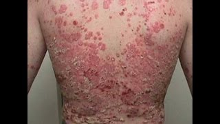 Guttate Psoriasis  What is Psoriasis amp How To Treat It [upl. by Blank]