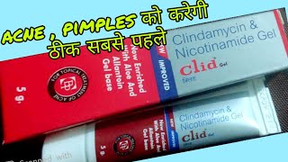 Clid gel for acne uses in hindi  clindamycin amp Nicotinamide gel review in hindi [upl. by Noyk]