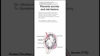 Placenta accreta and risk factors [upl. by Nezah]