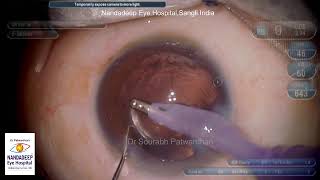 Soft Cataract 4 EDOF IOLs Dr Sourabh D Patwardhancataract phaco patwardhansourabhgmailcom [upl. by Alarice]