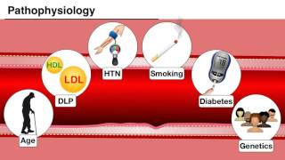 Ischemia 17  Introduction and pathophysiology of ACS [upl. by Adran]