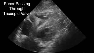 Emergency Transvenous Pacemaker Placement Guided w POCUS [upl. by Lovato]