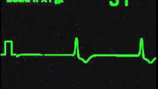 Idioventricular Rhythm  ECG Simulator  Arrhythmia Simulator [upl. by Clougher420]