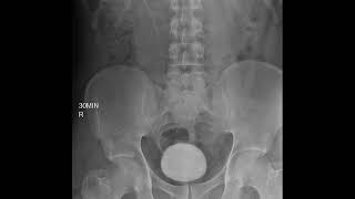 CASE 395 intravenous pyelography IVP left renal agenesis [upl. by Arrol]