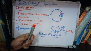 SENILE CATARACT very IMPORTANT topic ade simple part 3 [upl. by Liagaba]