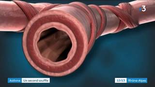 Thermoplastie bronchique  nouvelle thérapie pour les asthmatique sévères [upl. by Ginny]