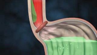 What to do about Acid Reflex GERD GastroEsophageal Reflux [upl. by Aldredge]