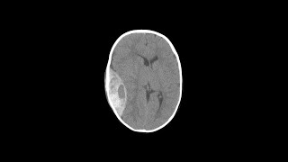 Types of Brain Herniations  Shorts [upl. by Camfort]