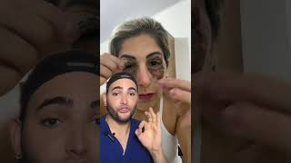 Peeling de Fenol en el contorno de Los ojos skincare beauty [upl. by Mordy]