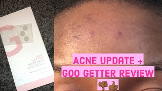 Goo Getter Zitsticka Review on my Acne  Forehead amp Skin Update  My 2021 New Year Skin Resolutions [upl. by Daj]