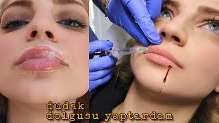 DUDAK DOLGUSU YAPTIRDIM Büşra Pektaş Vlog [upl. by Kelvin]