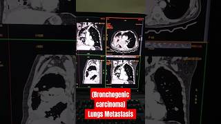 Bronchogenic carcinoma Lungs metastasis lungs cancer metastasis carcinoma hemantkushwah3453 [upl. by Nemzaj]