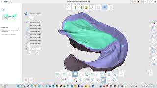 individual tray design with gnathometer [upl. by Acinorrev872]