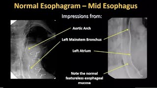 Imaging of the Esophagus and Stomach by Fiona Cassidy MD [upl. by Canter]