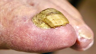 Super THICK BIG TOENAIL Trimming NAIL FUNGUS OR DAMAGED TOENAIL [upl. by Engamrahc]