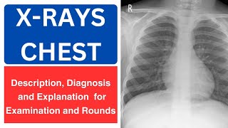 XRay chest basics diagnosis description and explanation for Rounds and TOACS XRAY [upl. by Begga805]