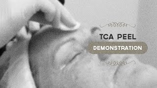 35 TCA peel demonstration [upl. by Etnuhs200]