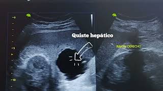 DOLOR ABDOMINAL POR QUISTE HEPATICO E HIDROCOLECISTO EN MASCULINO DE 62 AÑOS [upl. by Akvir]