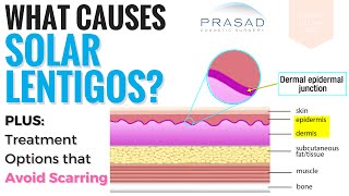 Causes and Treatments for Solar Lentigos [upl. by Ennahoj]