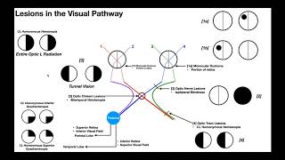 Lesions to the Visual Pathway EXPLAINED [upl. by Necyla]