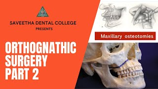 ORTHOGNATHIC SURGERY PART 2 [upl. by Anerac741]