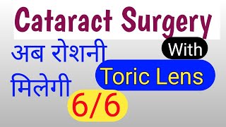 अब रोशनी मिलेगी 66 । toric lenses for cataract surgery। Toric lens price [upl. by Airegin306]