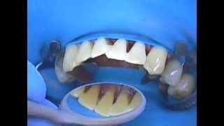 3 Dental Splinting  Conservative approach to strengthen teeth and reposition a lower incisor [upl. by Debee]