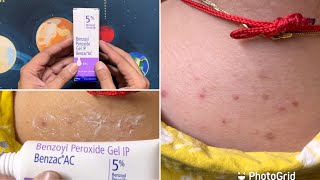 Benzoyl Peroxide Gel IP 5 Benzac AC ReviewUses amp Side Effects  Best Cream On Acne amp Pimples [upl. by Nwahsiek916]