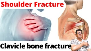 clavicle fracture in Hindi  broken collar boneकंधे का फ्रैक्चर  Clavicle bone fracture Treatment [upl. by Lain]