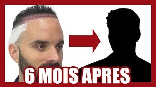 CALVITIE  MA GREFFE DE CHEVEUX  6 MOIS APRÈS [upl. by Seve260]