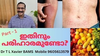 ചൂടുകുരു  Stop Heat Rashes Naturally Ultimate Guide [upl. by Ergener829]